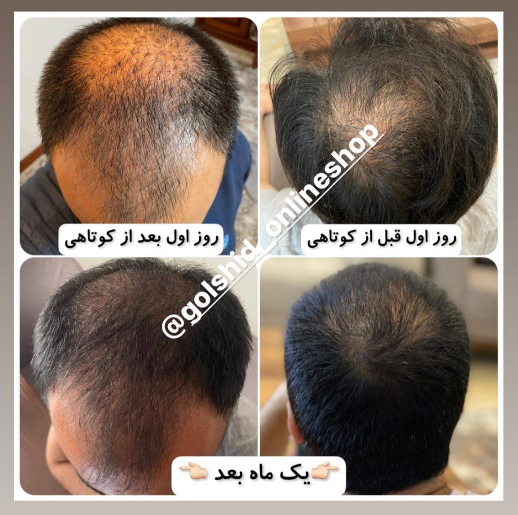 عکس قبل و بعد کیت رویش مجدد تراست