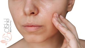 روتین پوست چرب