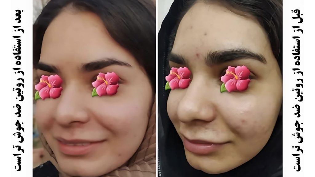 قبل و بعد استفاده از روتین ضد جوش